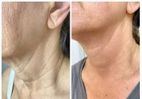 Fibroblast+Neck+Before+and+After+2